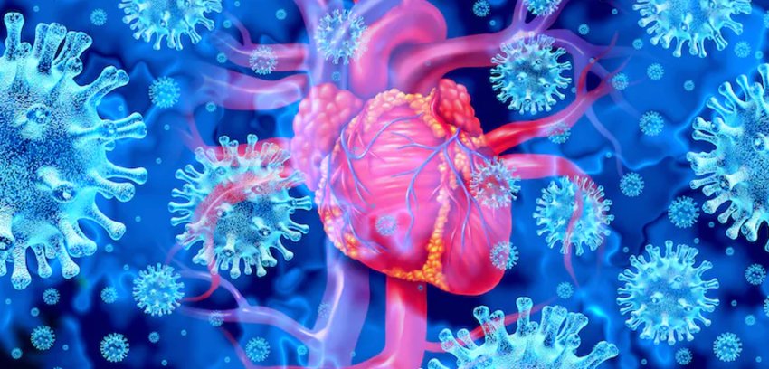 Inflammation of the heart (shown here), known as myocarditis, can be triggered by viral infection, including COVID-19, as well as from COVID-19 vaccination, in rare cases.